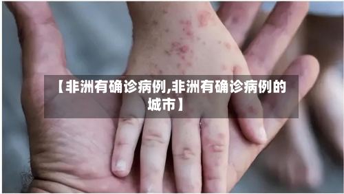 【非洲有确诊病例,非洲有确诊病例的城市】-第2张图片